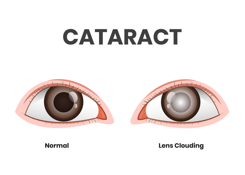 Overcoming My Fear About Cataract Surgery